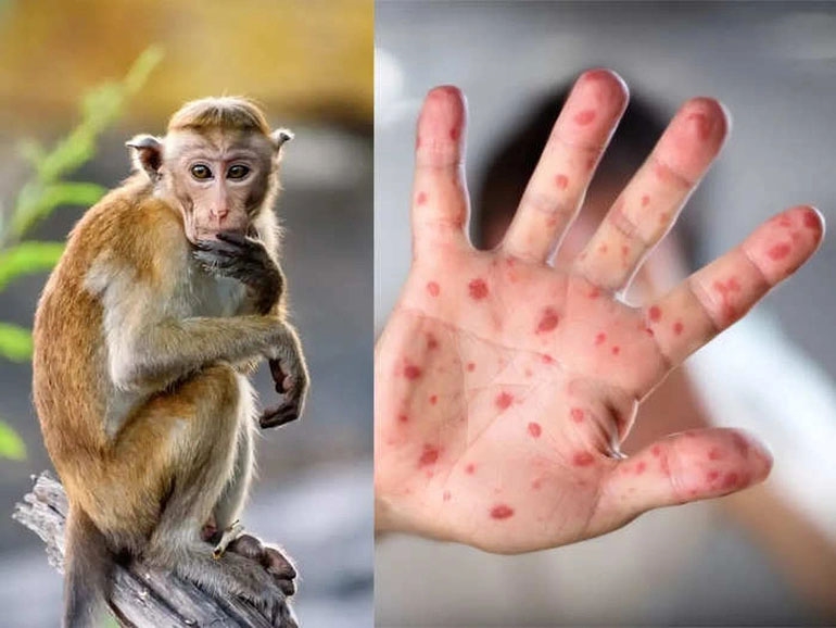 Nâng cao cảnh giác với bệnh đậu mùa khỉ. Bệnh đậu mùa khỉ. Đậu mùa khỉ